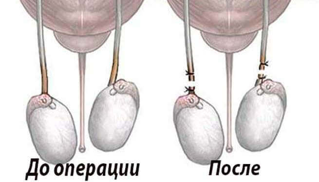 Вазектомія або стерилізація чоловіка Вазектомія або стерилізація чоловіка