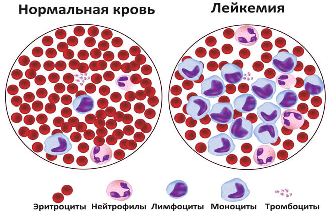 Що таке цитопенія і причини її появи