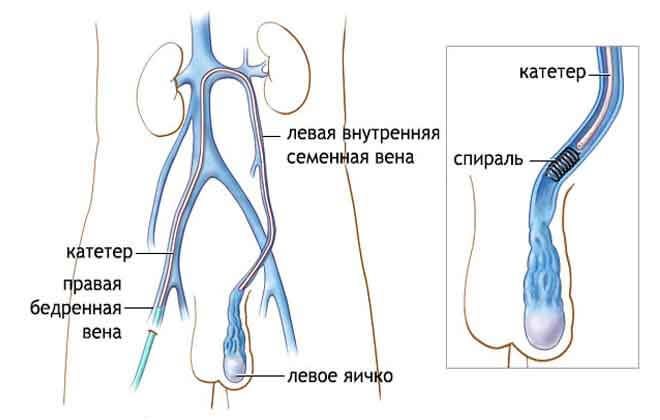 Причини двостороннього варикоцеле і методи її лікування