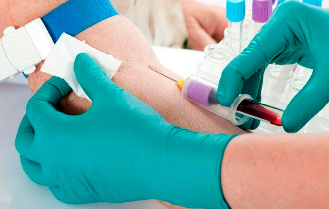 В якому випадку призначають ревматоїдні проби і як розшифровують результати