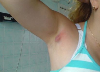 фото чиряка під пахвою фото чиряка під пахвою