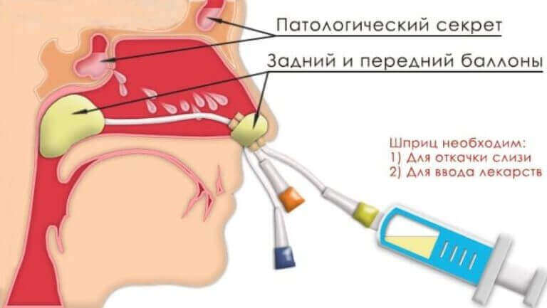 ЯМІК процедура при гаймориті ЯМІК процедура при гаймориті
