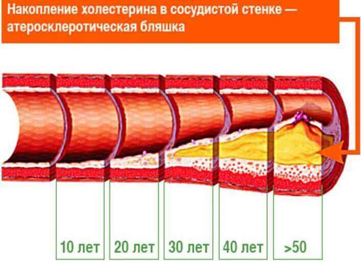 Способи профілактики атеросклерозу судин Способи профілактики атеросклерозу судин