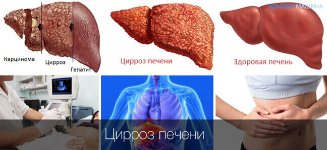Дженерики від гепатиту С Дженерики від гепатиту С