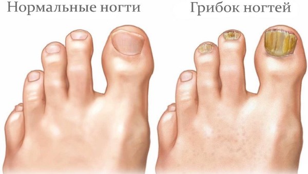 Мазі від грибка нігтів на ногах і руках Мазі від грибка нігтів на ногах і руках