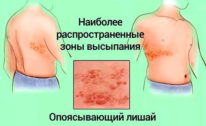 Симптоми оперізувального лишаю Симптоми оперізувального лишаю