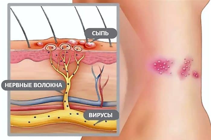 Причини виникнення оперізувального лишаю Причини виникнення оперізувального лишаю