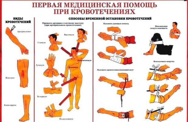 Перша допомога при кровотечі Перша допомога при кровотечі