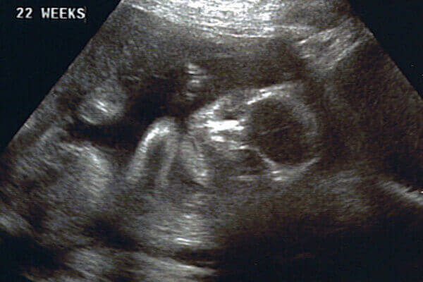 22 тиждень вагітності УЗД 22 тиждень вагітності УЗД