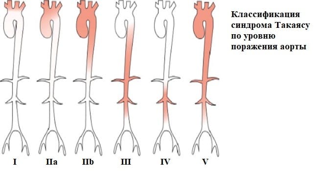 Причини і симптоми хвороби Такаясу Причини і симптоми хвороби Такаясу