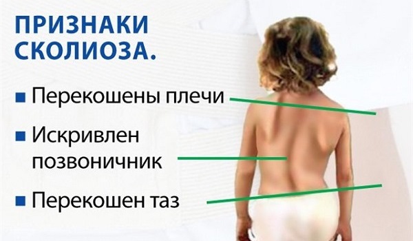 Причини викривлення хребта у дітей Причини викривлення хребта у дітей