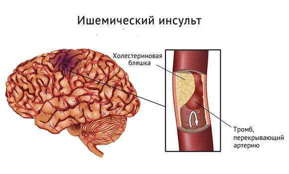 Ішемічний інсульт: причини, симптоми, лікування Ішемічний інсульт: причини, симптоми, лікування