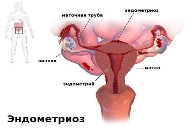 Як зупинити маткову кровотечу при ендометріозі Як зупинити маткову кровотечу при ендометріозі