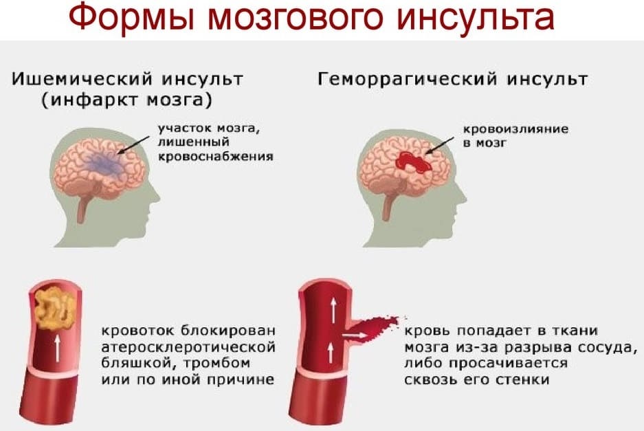 Чи може бути інсульт у дітей? Чи може бути інсульт у дітей?