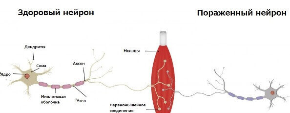 Відмінність хворого нейрона від здорового Відмінність хворого нейрона від здорового