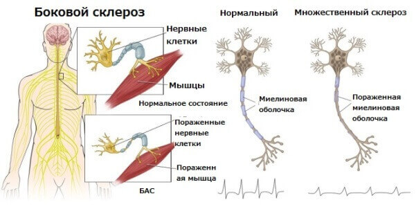 Що відбувається з нейроном при БАС Що відбувається з нейроном при БАС
