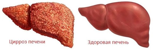 Криптогенний гепатит Криптогенний гепатит