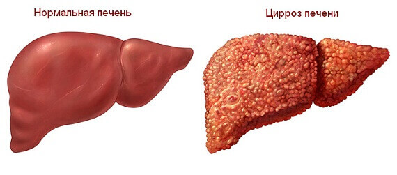 Цироз печінки Цироз печінки