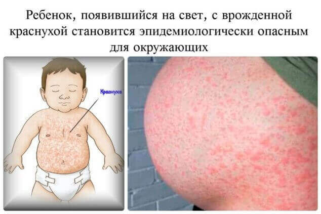 Краснуха: симптоми, як виглядає, причини, лікування Краснуха: симптоми, як виглядає, причини, лікування