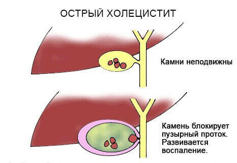 Гострий холецистит Гострий холецистит