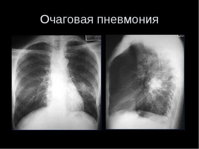 Пневмонія у немовляти Пневмонія у немовляти