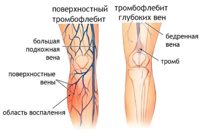 Чим відрізняється варикоз вен від тромбофлебіту? Чим відрізняється варикоз вен від тромбофлебіту?