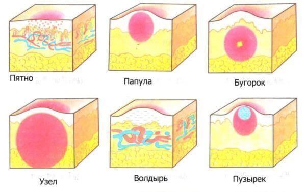 Характеристика висипань на обличчі Характеристика висипань на обличчі