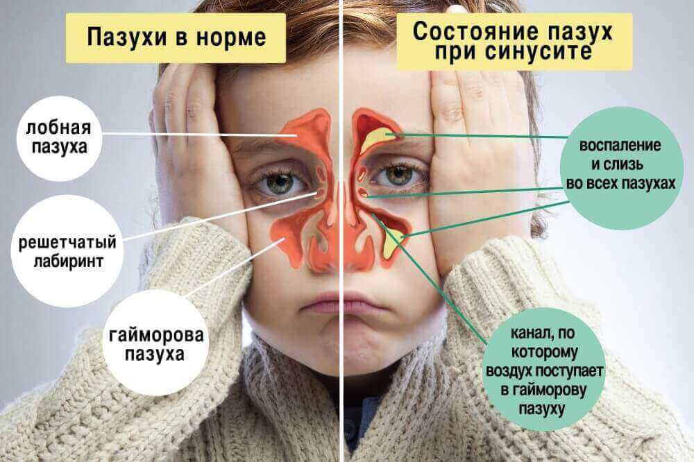 Синусит - симптоми хвороби Синусит - симптоми хвороби