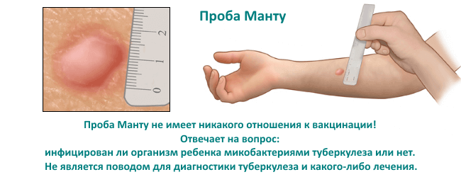 Проба Манту Проба Манту