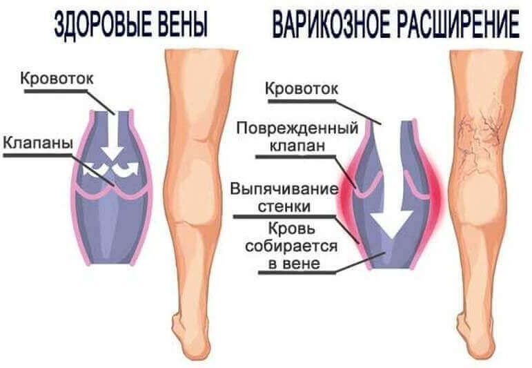 Чим відрізняється варикоз від тромбофлебіту Чим відрізняється варикоз від тромбофлебіту