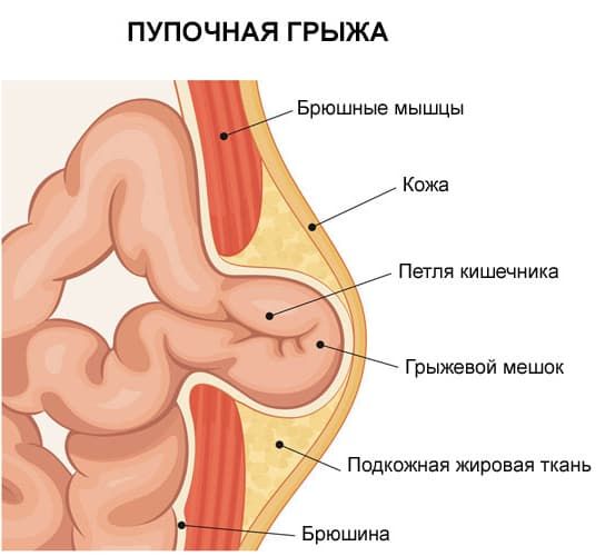 пупочная грыжа