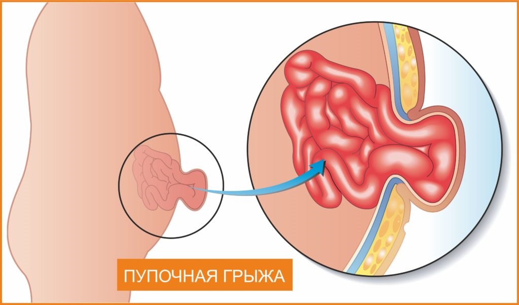 пупочная грыжа